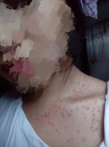 因为细菌和热毒感染起来的皮肤病怎么治,之前吃过软胶囊类的药,好了