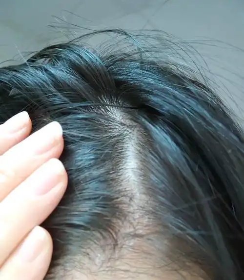 天一冷就头痒很多头皮