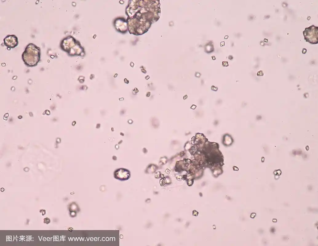 尿中的尿酸结晶