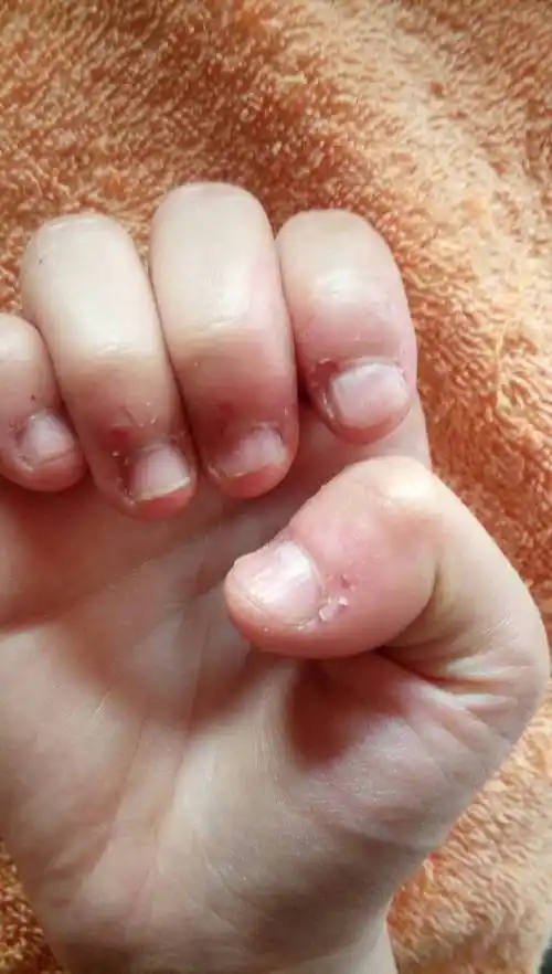 我喜欢啃指甲,从小就啃,啃了十多年了,现在再留,还留的好吗?