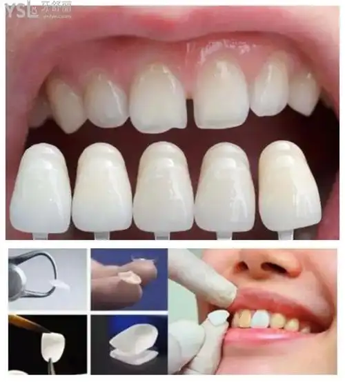 牙贴面影响正常的牙吗?网友说建议门牙千万不要做贴面是真的吗?戳这里