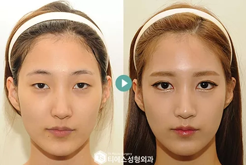 ts和id眼部整形案例对比谁做的双眼皮更自然