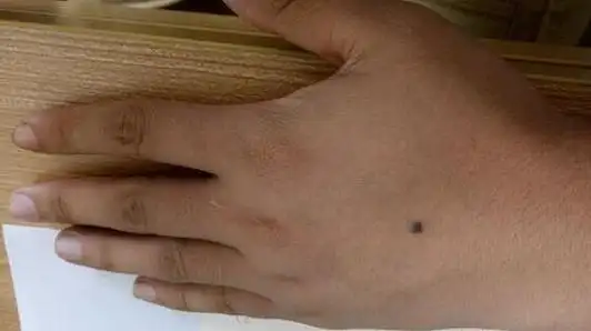 手背长痣代表什么