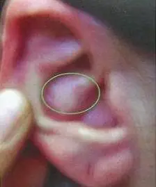 呃逆图十四:便秘由上图可以看出,一般当人体有疾病时,在耳朵上都会有