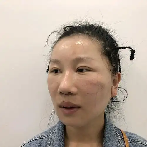 小切口拉皮人中缩短术后1周