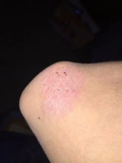 胳膊肘哪里发红,然后起皮,一挠就掉皮.不传染,好像也没扩.