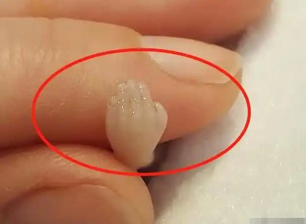 妈妈怀孕14周意外流产胎儿模样曝光才10厘米但手脚已成形