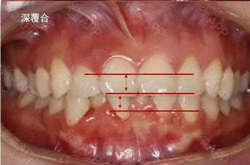 这个算牙齿深覆合吗
