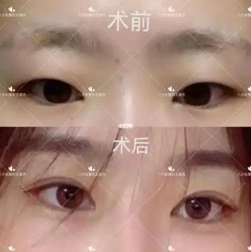 王淑杰双眼皮案例分享_双眼皮_眼部_全切双眼皮_单眼皮_双眼皮手术_肿