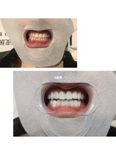 全瓷贴面效果对比图_亮白牙齿_美牙_美妆_医美整形