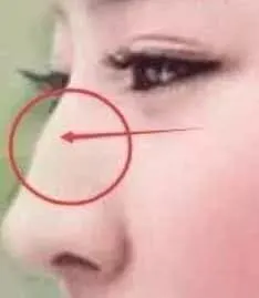 五,鼻梁尖削,凸起