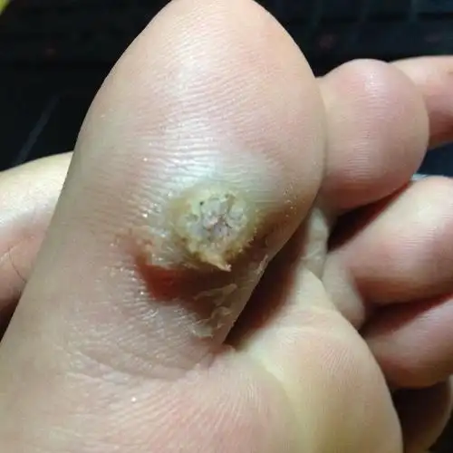 请问我的鸡眼这种程度要怎么治疗!贴了好多片了,之前能撕了两次硬硬