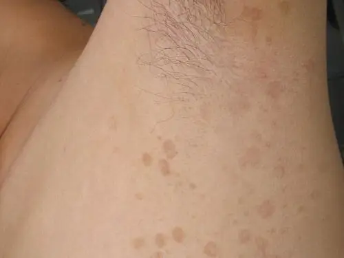 怎么做可以预防花斑癣出现_花斑癣_北京京城皮肤病医院(北京医保定点