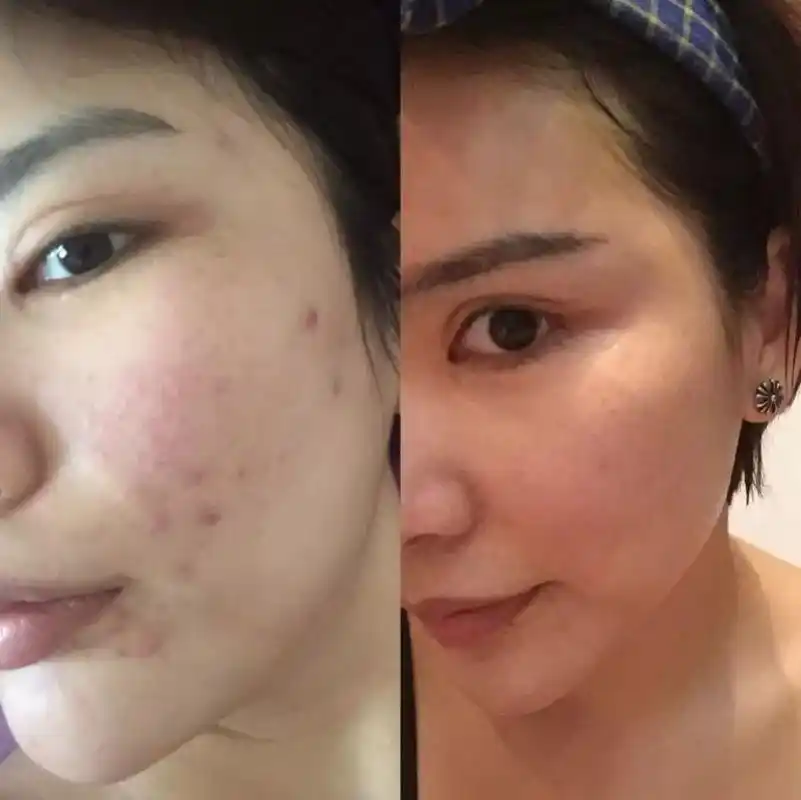 黑头泛滥,痘痘横生,毛孔堵塞的终极杀手开始接单啦!