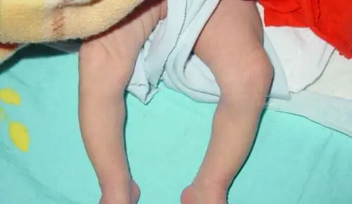 新生儿佝偻病婴儿局部图片_有来医生