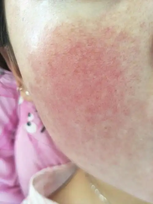 脸上出现红血丝可不是一件小事,这可能就是皮肤发出的缺水信号,我们是