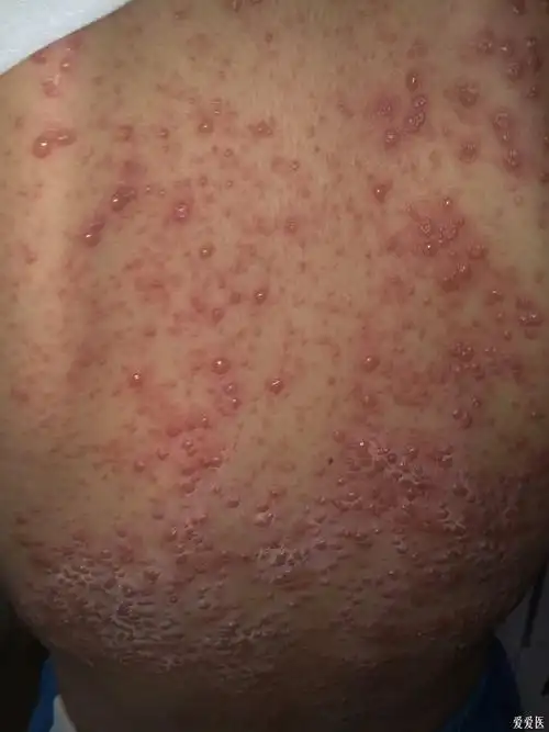 患儿1月前出现双下肢,双侧臀部散在皮疹,当时诊断"过敏性紫癜",予西米