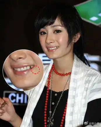 脸变小的文案,关键是杨幂拔的不是智齿,拔的是左右小虎牙后面那一颗