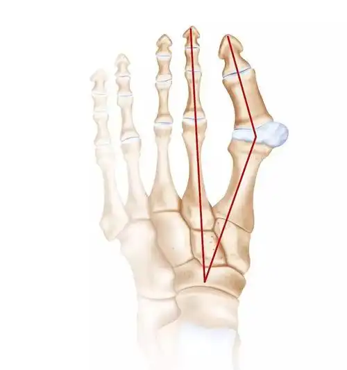拇趾向外偏斜,拇趾近节趾骨与第1跖骨成角大于15°,有"大脚骨","大觚