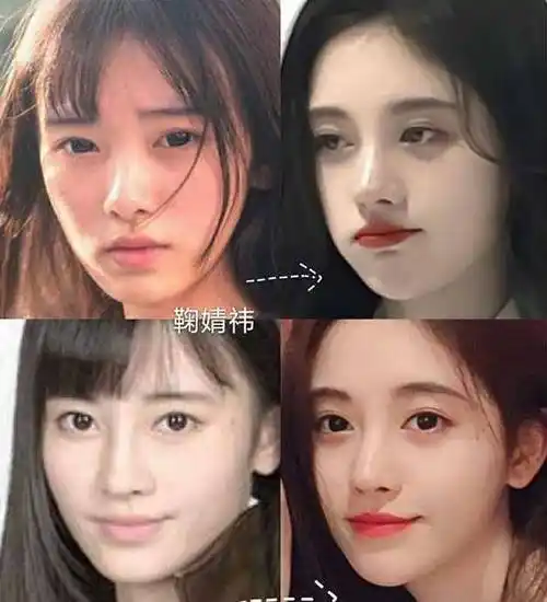 根据过去和现在的对比图可以看出,鞠婧祎过去脸型较宽,五官扁平,眼睛