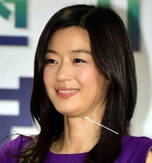 *下巴后缩型:因下巴短小后缩,皮肤及软组织堆挤在一起.