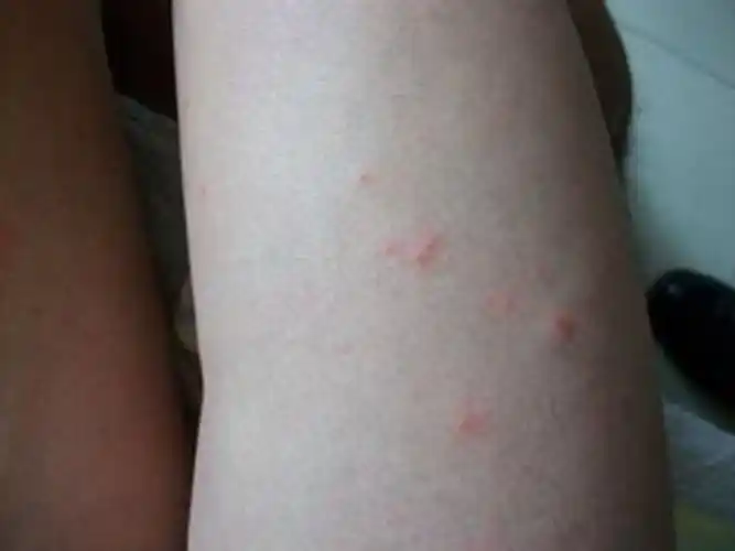 孕妇疥疮初期腹部皮肤症状图片