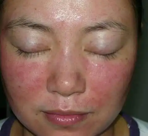 敏感肌肤几个特征快来检测一下