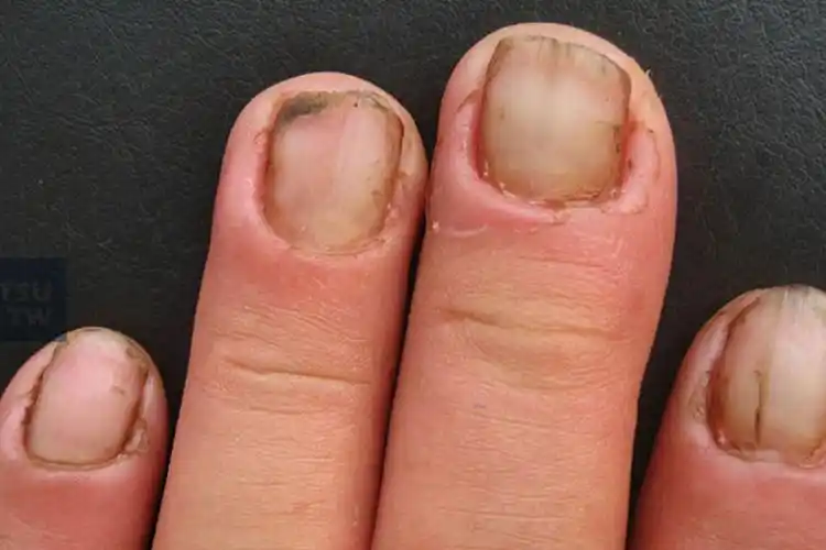 念珠菌性甲沟炎是从甲沟近端皱襞开始发生表现为甲皱襞肿胀,红斑伴
