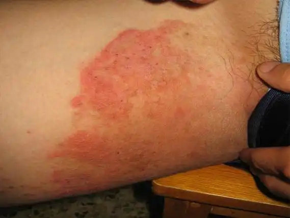 股癣是指发于人体股内侧,腹沟部,会阴,臀部感染真菌后引起的伴有瘙痒