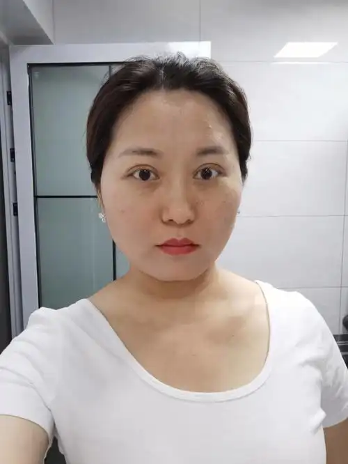 做完双眼皮第95天的眼睛