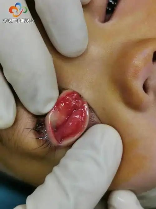 1岁半男孩眼皮红肿 竟是因眼睑里长了十几个这种"包"|睑板|囊肿|疤痕