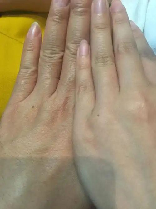 今天无意间发现和女朋友手背同一个位置长了一个痣,请教各位指点迷津