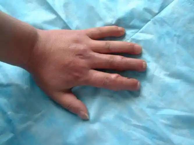 手指再造 - 好大夫在线