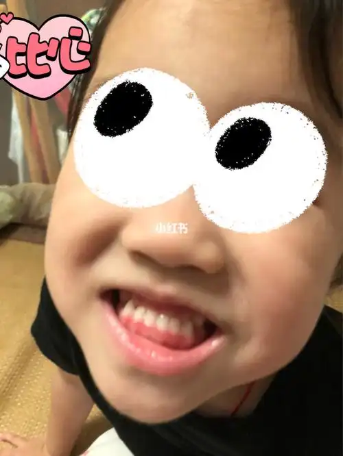 小朋友反颌,地包天,早干预早治疗.