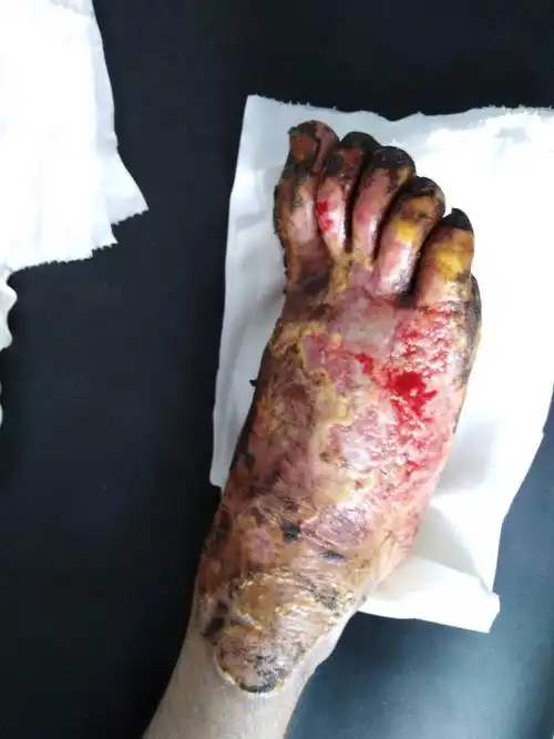 滑县康太福利医院烧伤烫伤术后刀口不愈合案例