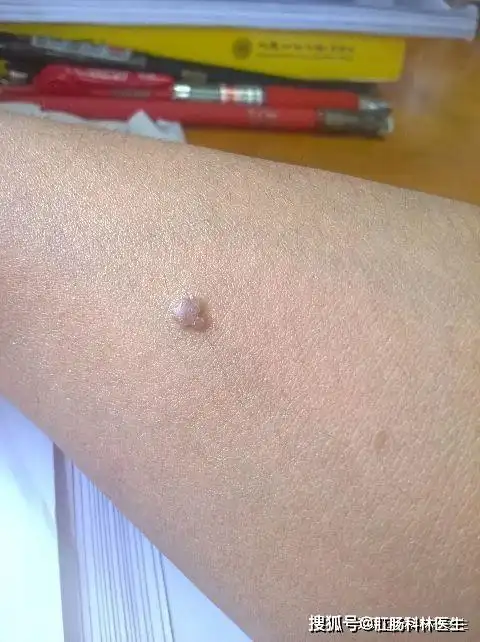 是什么原因才长了扁平疣?听听专家怎么说