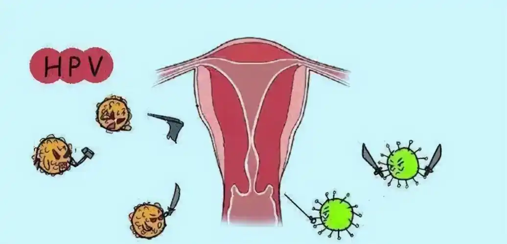 妇科炎症有哪些症状(女性妇科炎症怎么治疗)插图