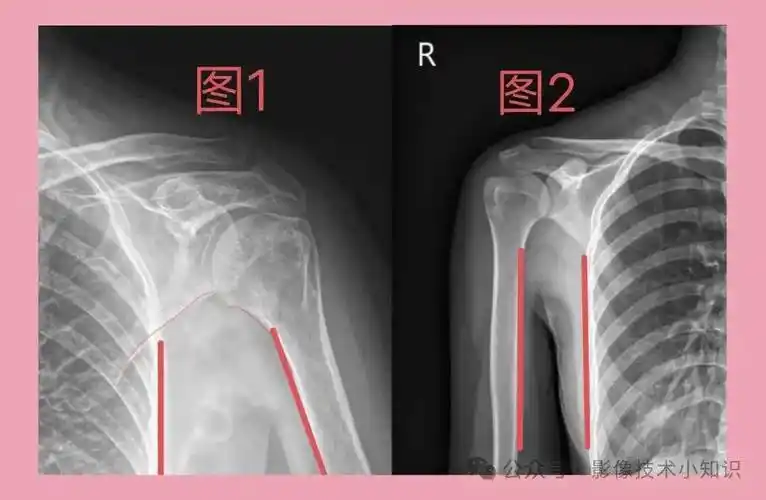 肩关节内收和外展, 对影像诊断的影响