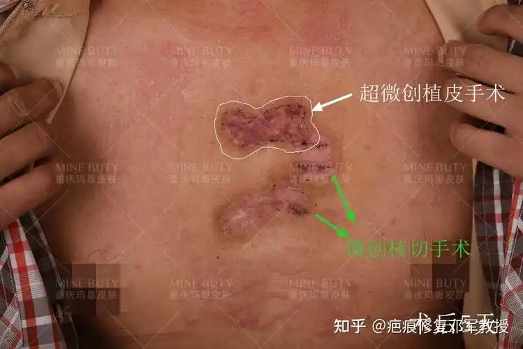 采用了微创核切手术白色画线区域为采用超微创植皮手术后恢复的情况
