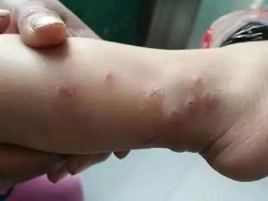 蚊虫叮咬小腿长多个疙瘩并结痂图