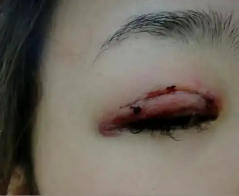 双眼皮手术失败案例图