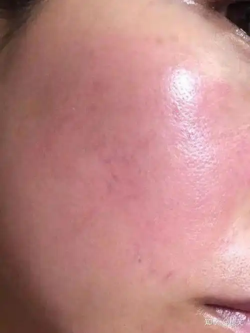 推荐#珀芙研修护大红脸角质层薄图片大全类固醇注射后皮肤泛红