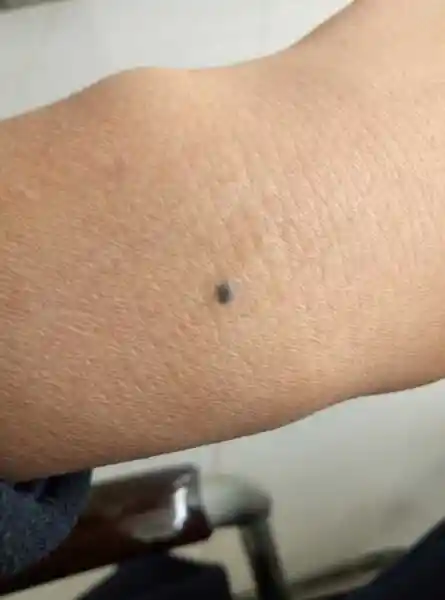 手腕上这个是什么?长了好多年了