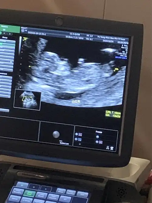 这是男宝还是女宝 ,昨天做的nt咱也不敢问医生