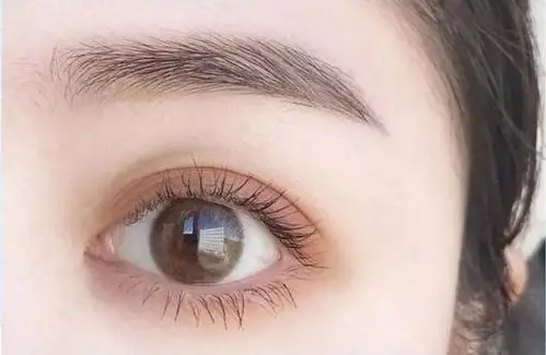 如何才能拥有自然美观的双眼皮