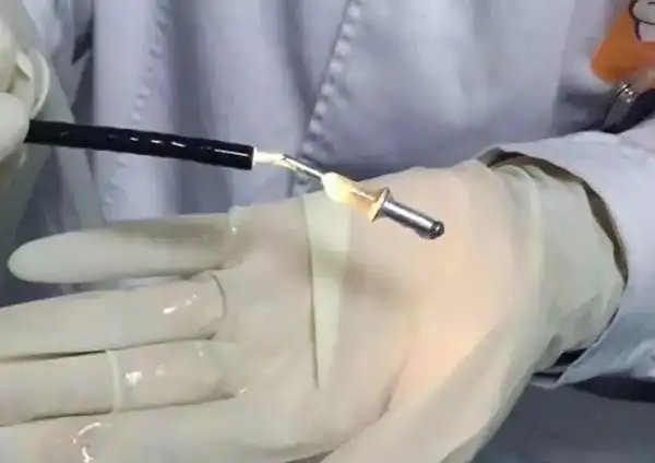 医院新闻-医生用活检钳取出滑进张先生肺里的钉子---powered by