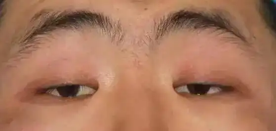 自测:你的眼睑下垂了吗?【昆明华美美莱】_云南华美美莱整形美容医院