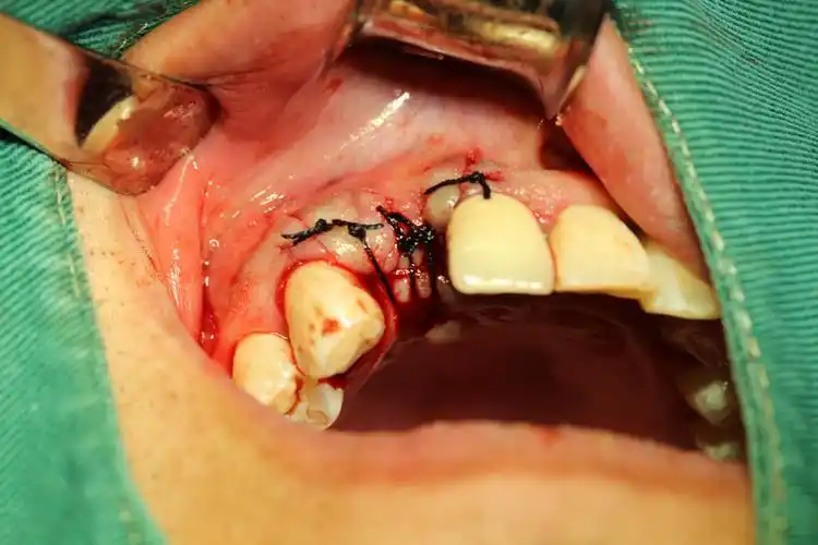 华盛2018一例前牙美学区种植 写美篇术中患者无任何不适,并且手术时间