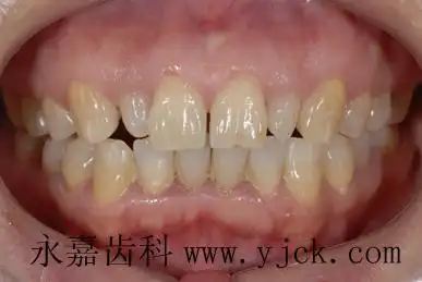 侧切牙畸形可以这么修复