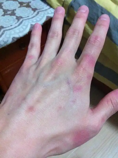 前一阵患了多形红斑 大概20天左右好了 之后手背上一直留着红印子消失